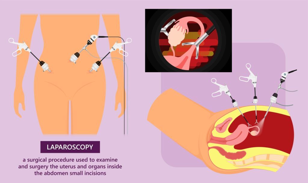 Laparoscopic surgery for treatment fibroids and cysts in the uterus biopsy