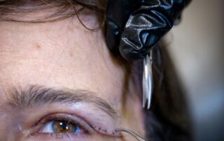 Gloved hands work on an eye with cosmetic markings